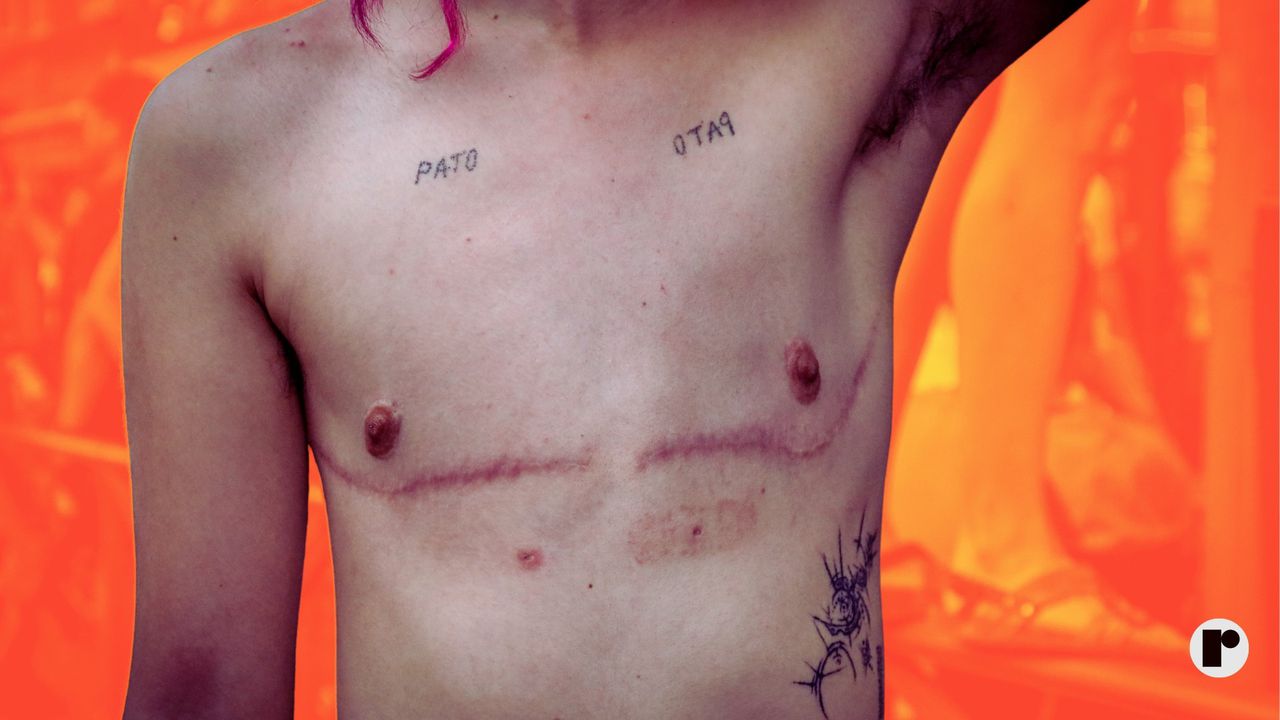 A protester with the scars of mastectomy seen along Bravo Murillo street during the demonstration.