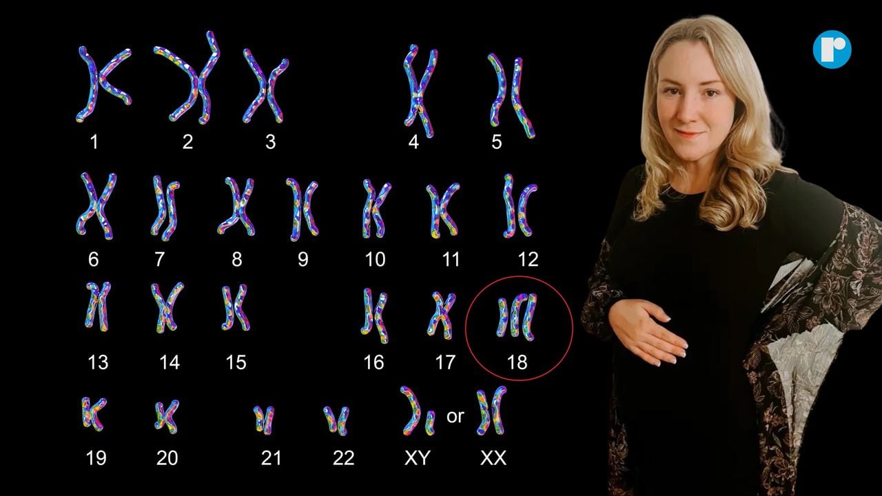 What is trisomy 18, the condition causing a Texas woman to flee the state for abortion?